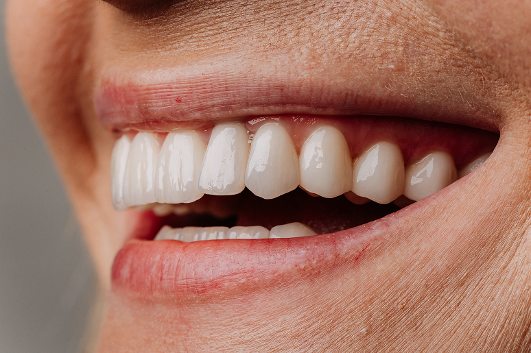 Implant bridges