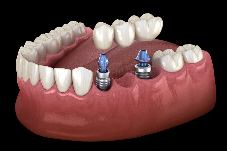 Dental bridge supported by two implants illustration