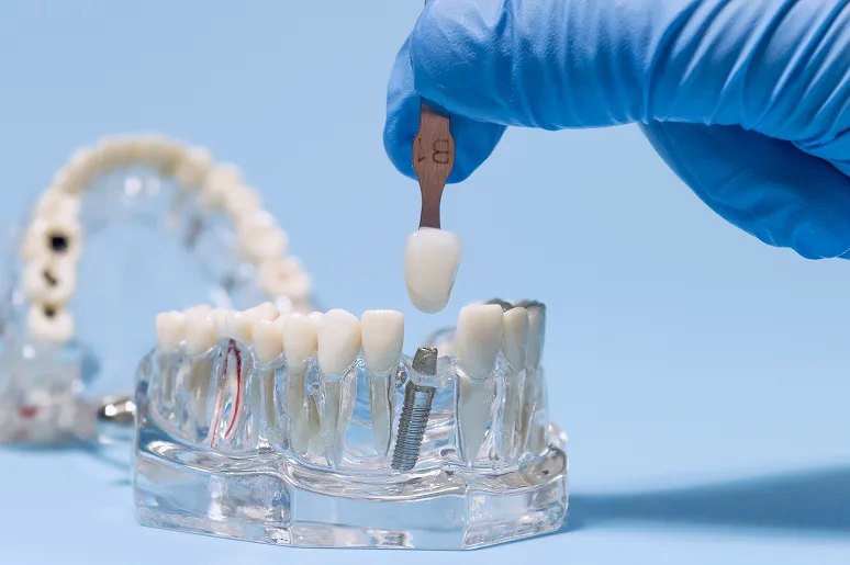 Single & multiple implants