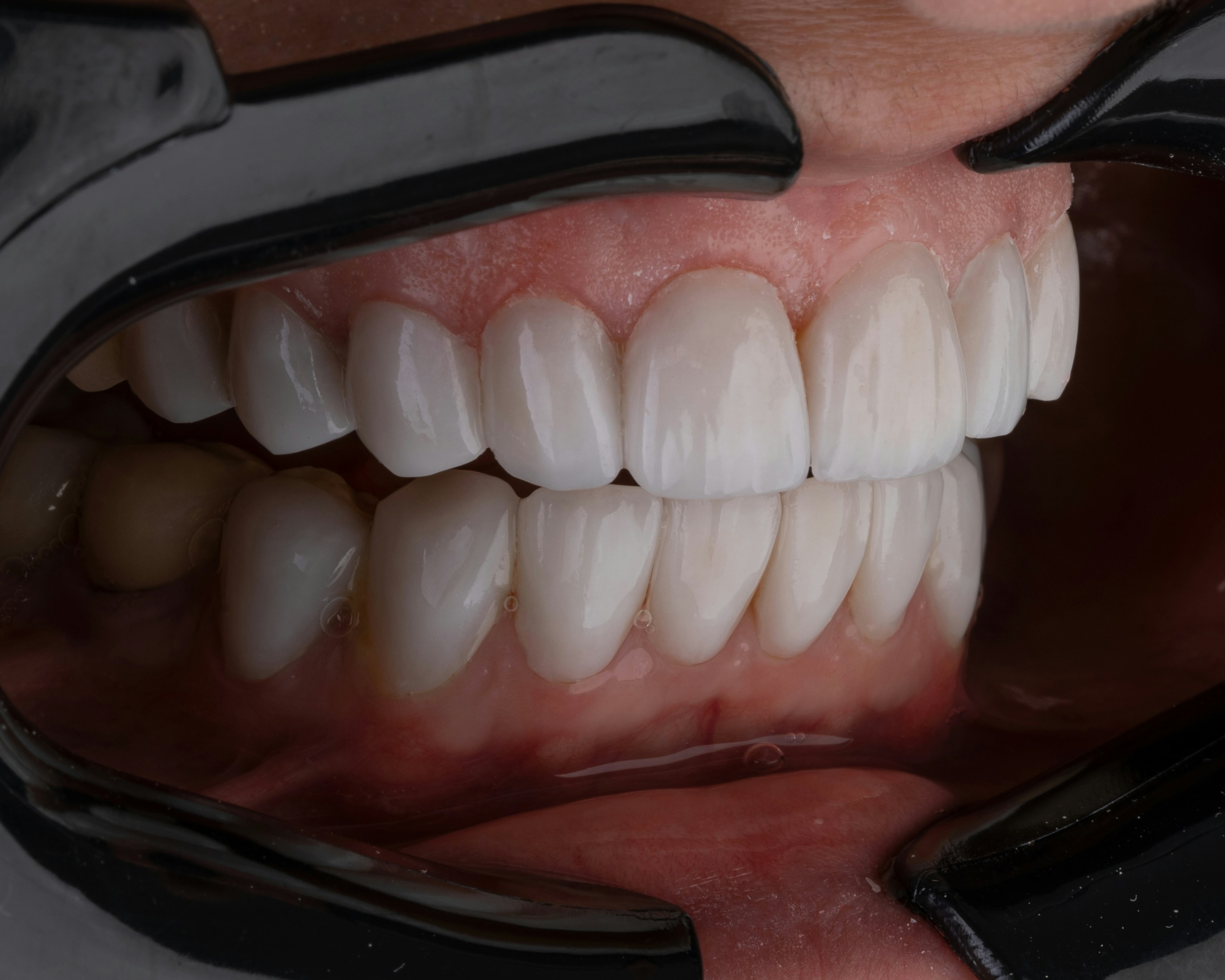 Full-arch fixed teeth