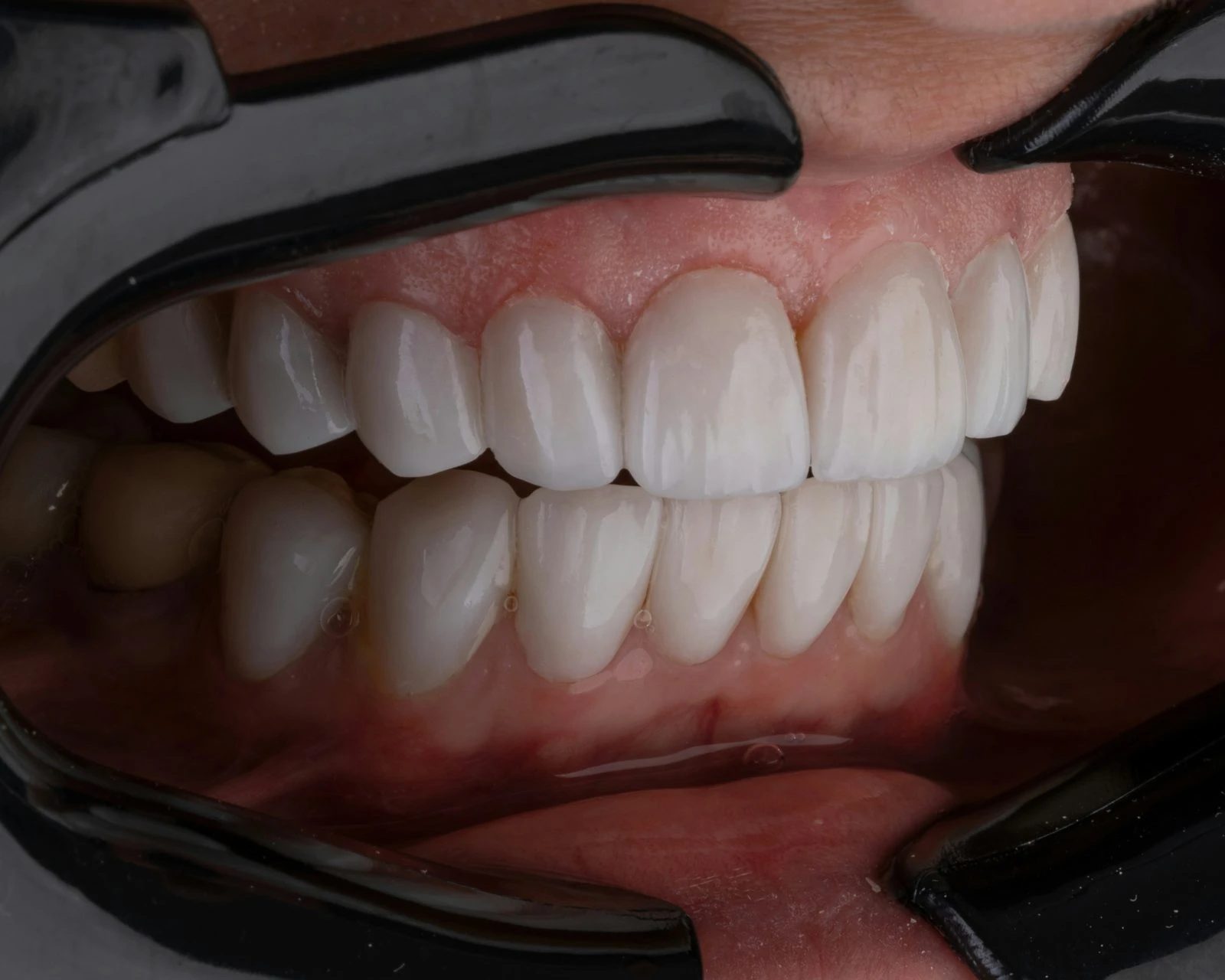 Full-arch fixed teeth