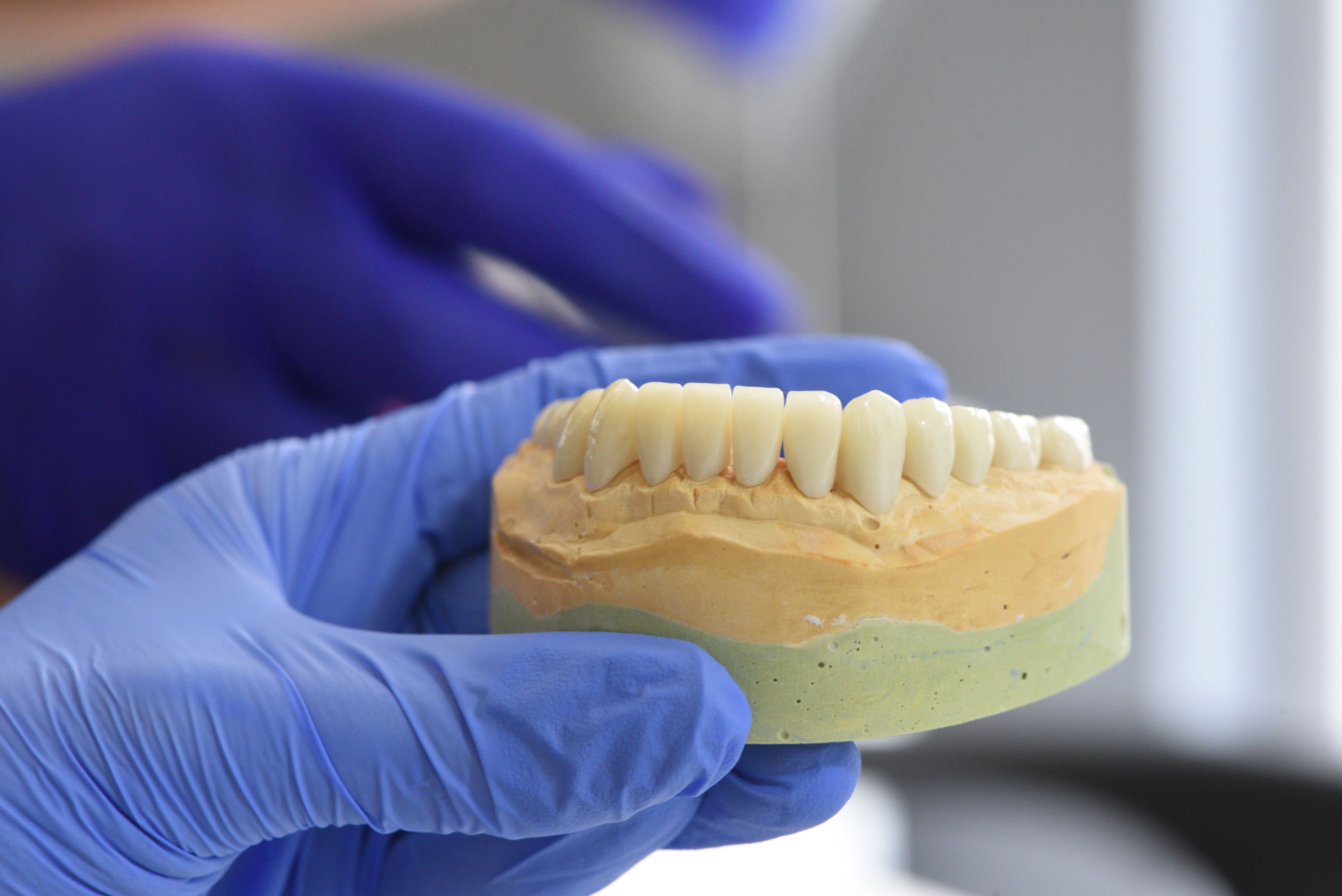 Patient showing natural-looking implant bridge result