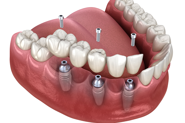 Patient consultation for implant bridge candidacy