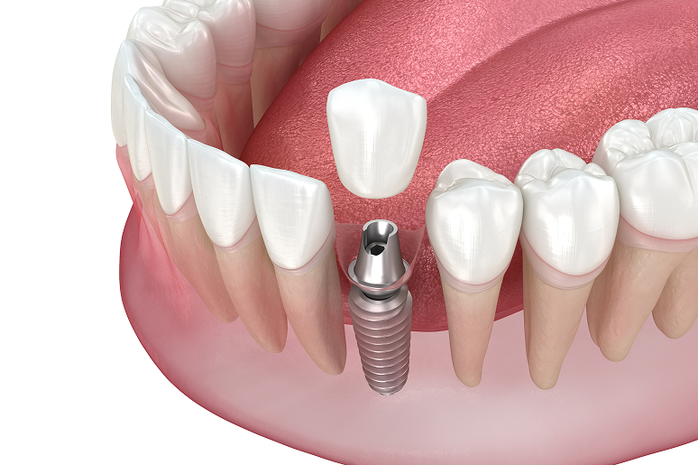 Patient with a restored single tooth implant smile