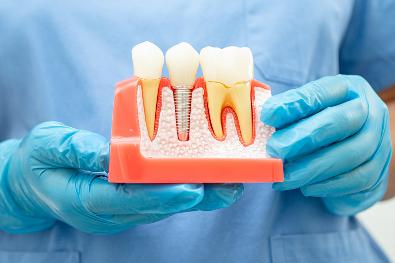 Close-up of a single dental implant crown